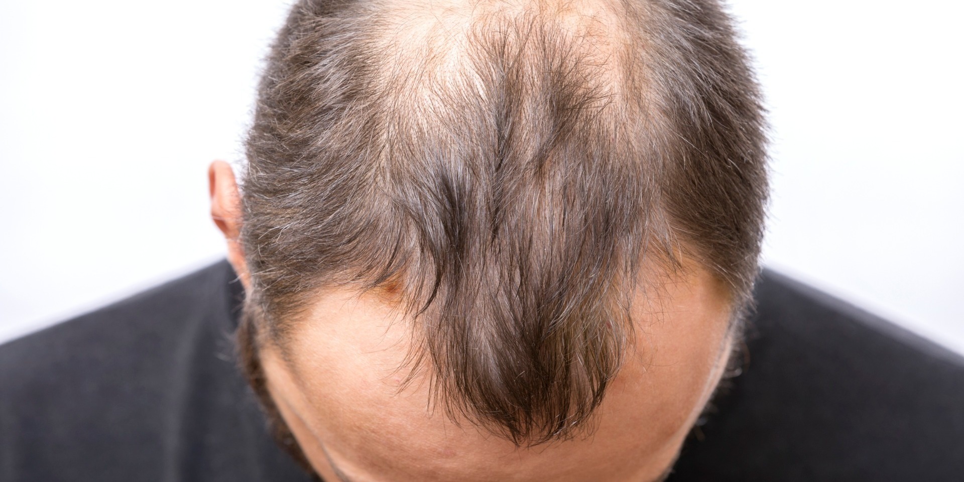 Myths about Alopecia Areata